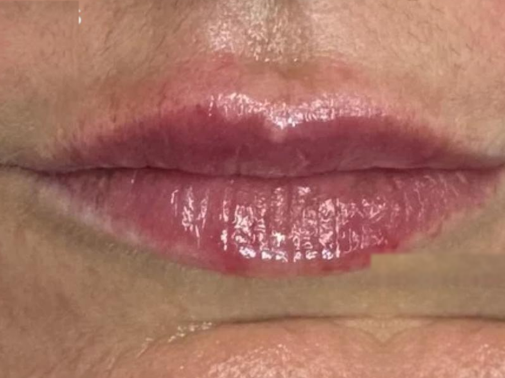 Aumento de labios — Después